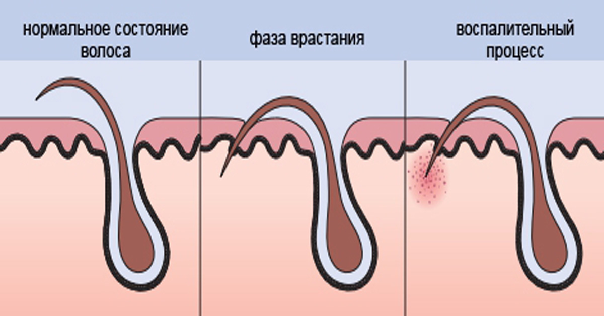 Вросло В Кожу Фото